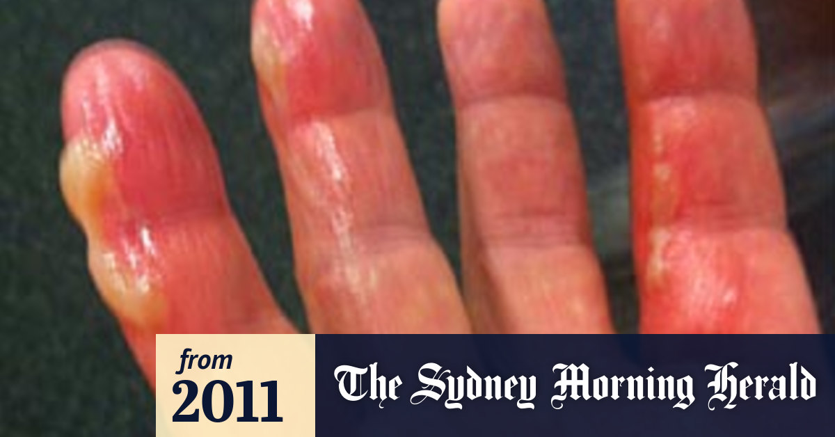 A hamfisted start to Big Bash